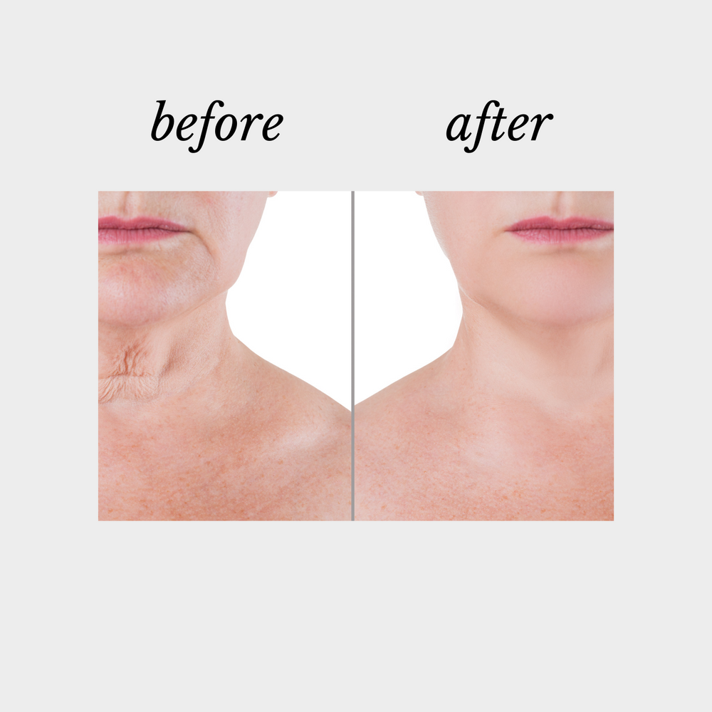 Collagen Neck Repair | Defy Cosmeceuticals, Beauty on Rose, Essendon, Melbourne, Australia